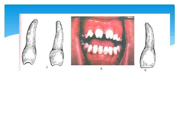 а, б – зубы Гетчинсона, в – зубы Фурнье 