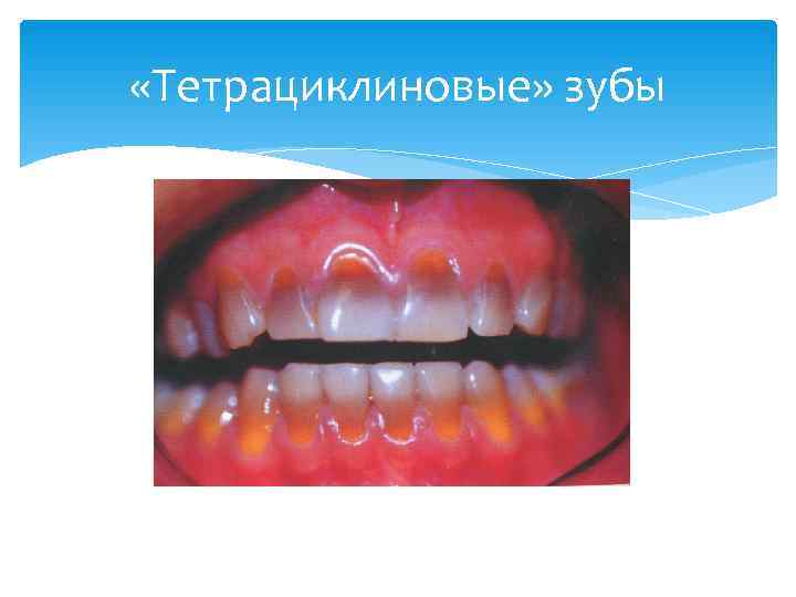  «Тетрациклиновые» зубы 