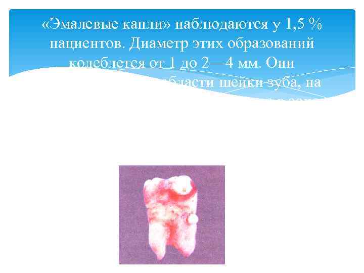  «Эмалевые капли» наблюдаются у 1, 5 % пациентов. Диаметр этих образований  колеблется