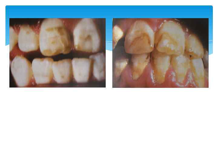 Пятнистая форма флюороза 