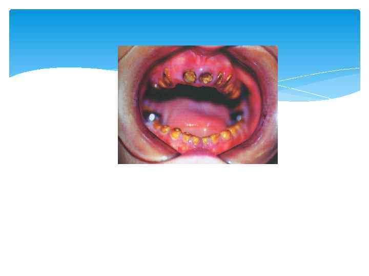 Синдром Стейтона-Капдепона 