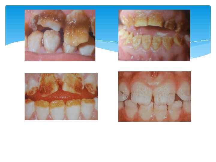 Несовершенный амелогенез 