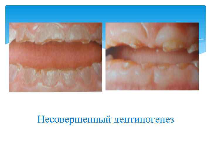 Несовершенный дентиногенез 