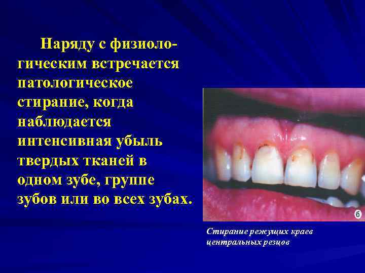   Наряду с физиоло- гическим встречается патологическое стирание, когда наблюдается интенсивная убыль твердых