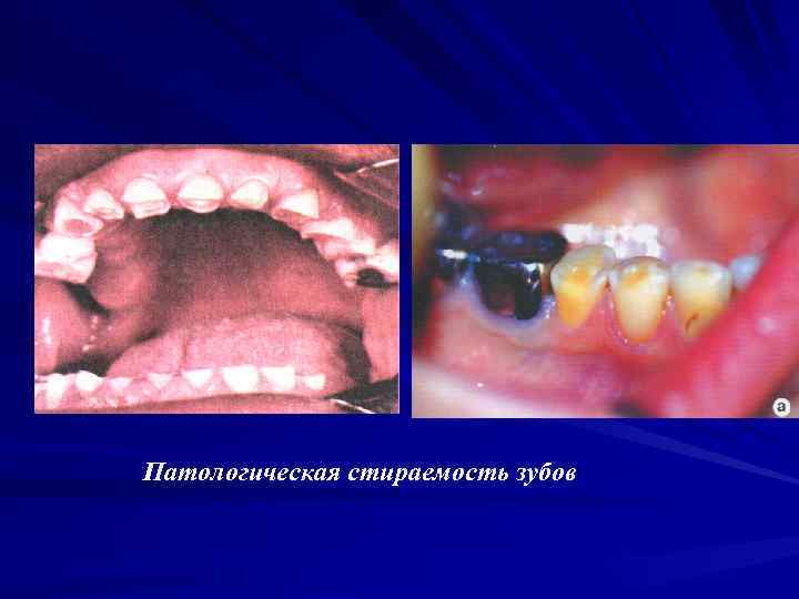 Патологическая стираемость зубов 