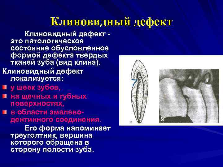   Клиновидный дефект -  это патологическое  состояние обусловленное  формой дефекта