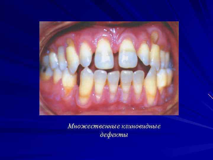 Множественные клиновидные  дефекты 
