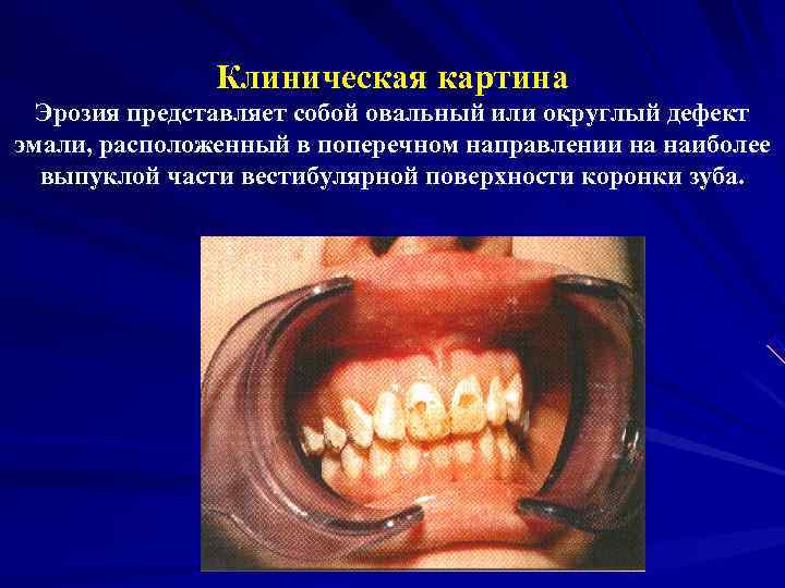     Клиническая картина  Эрозия представляет собой овальный или округлый дефект