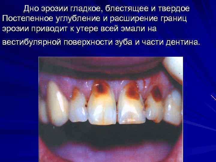  Дно эрозии гладкое, блестящее и твердое Постепенное углубление и расширение границ эрозии приводит