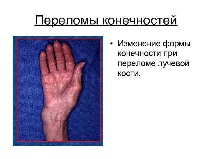 Переломы конечностей  • Изменение формы   конечности при   переломе лучевой