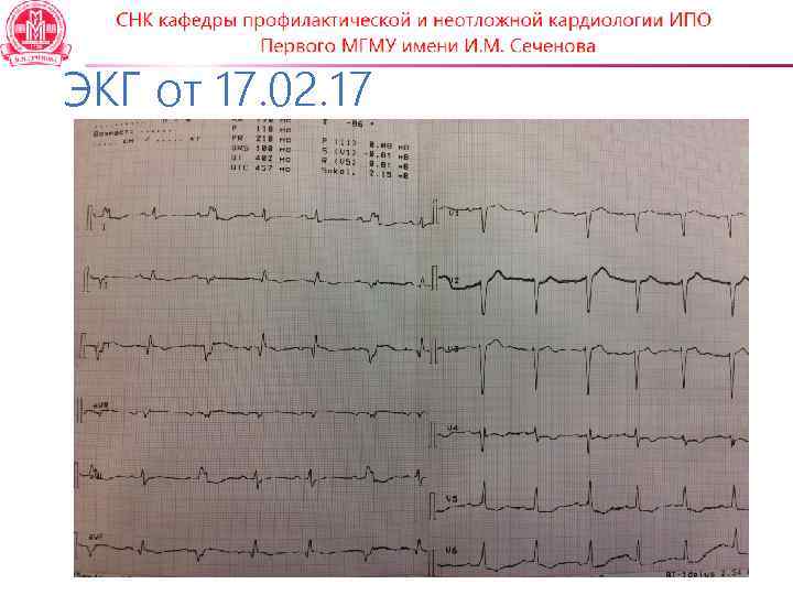 ЭКГ от 17. 02. 17 