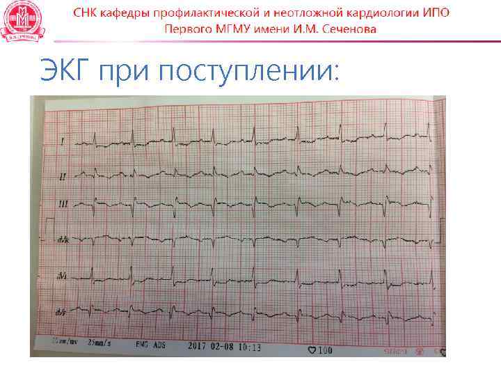 ЭКГ при поступлении: 