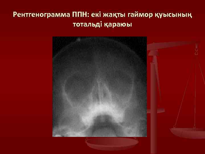 Рентгенограмма ППН: екі жақты гаймор қуысының    тотальді қараюы 