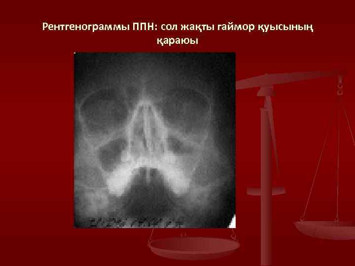 Рентгенограммы ППН: сол жақты гаймор қуысының    қараюы 