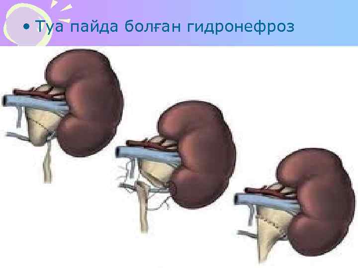  • Туа пайда болған гидронефроз 