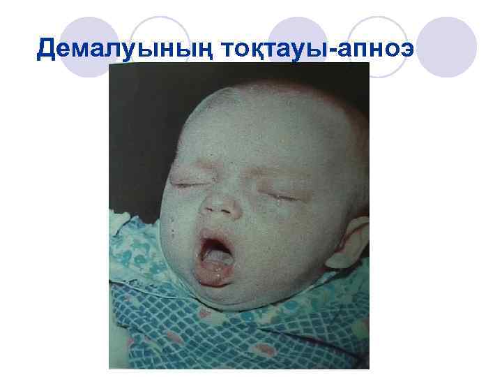 Демалуының тоқтауы-апноэ 