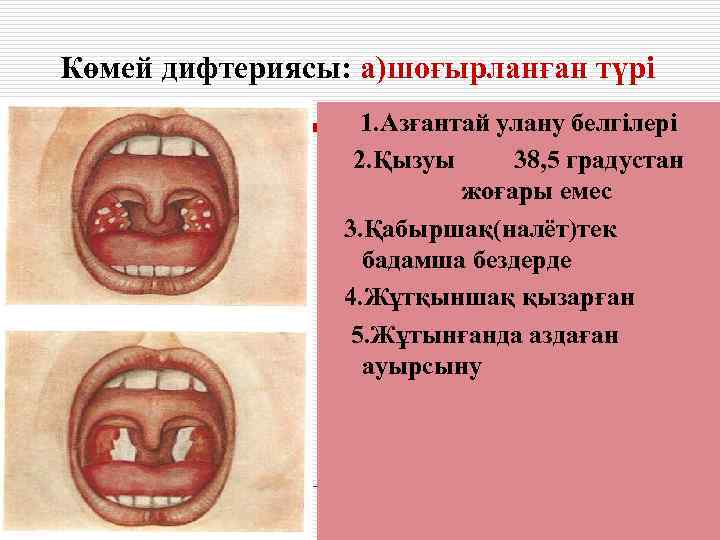 Көмей дифтериясы: а)шоғырланған түрі    1. Азғантай улану белгілері   