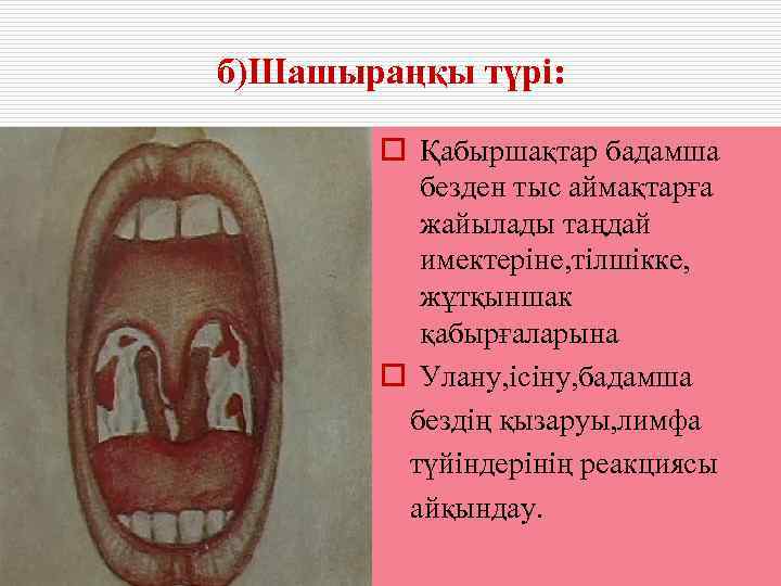 б)Шашыраңқы түрі:   o Қабыршақтар бадамша   безден тыс аймақтарға  