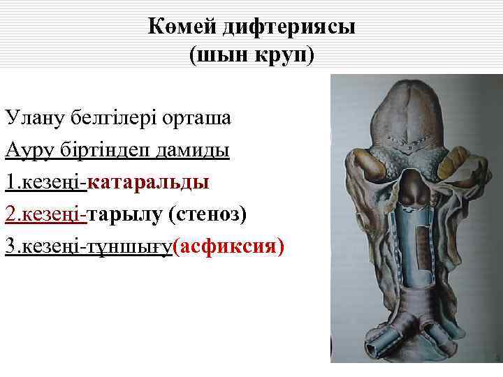    Көмей дифтериясы   (шын круп) Улану белгілері орташа Ауру біртіндеп