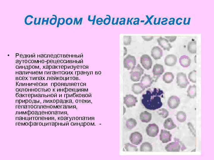  Синдром Чедиака-Хигаси  • Редкий наследственный  аутосомно-рецессивный  синдром, характеризуется  наличием
