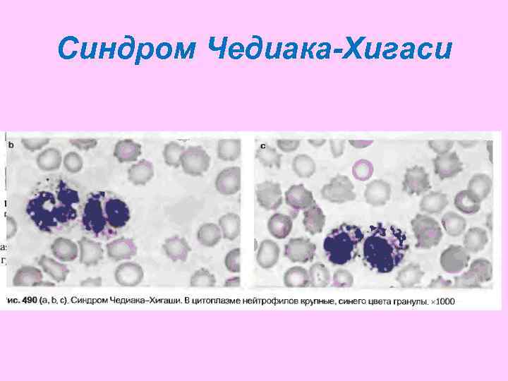Синдром Чедиака-Хигаси 