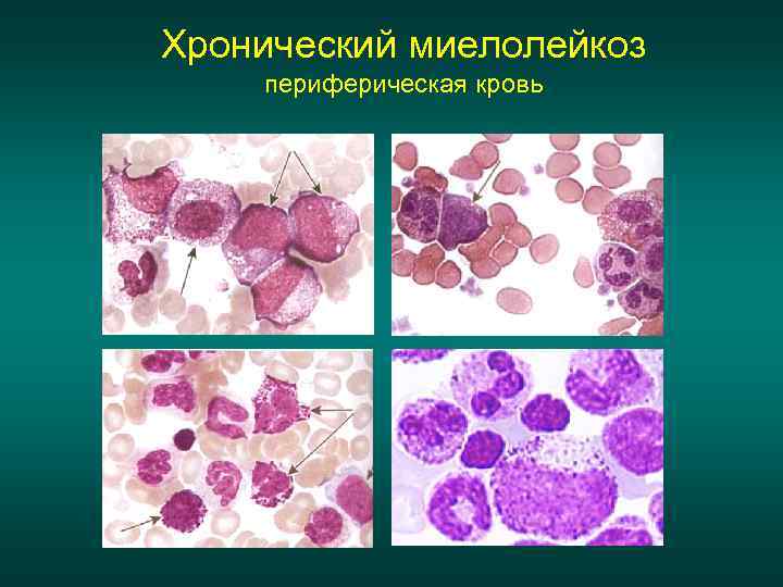 Хронический миелолейкоз периферическая кровь 