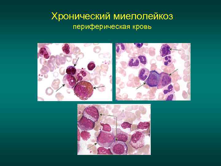Хронический миелолейкоз периферическая кровь 
