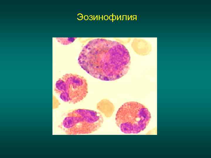 Эозинофилия 