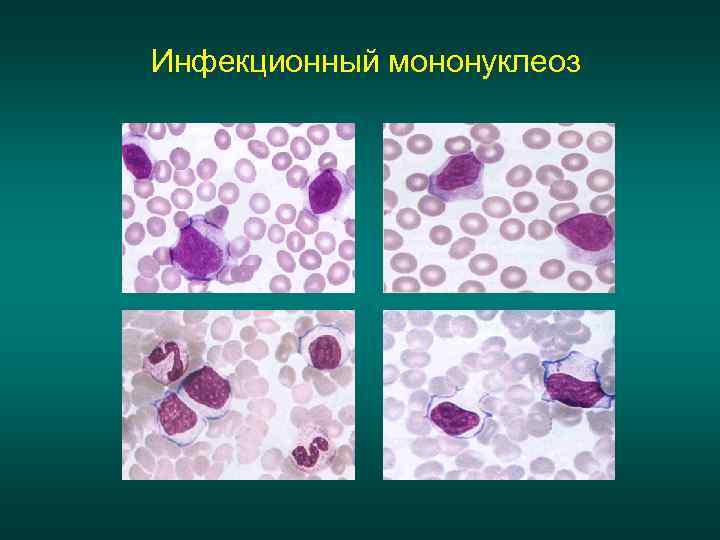 Инфекционный мононуклеоз 