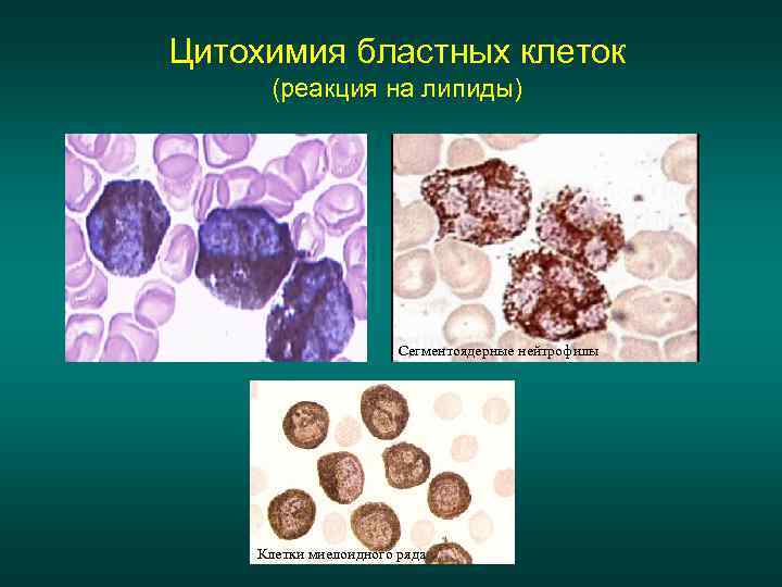 Цитохимия бластных клеток (реакция на липиды)      Сегментоядерные нейтрофилы 