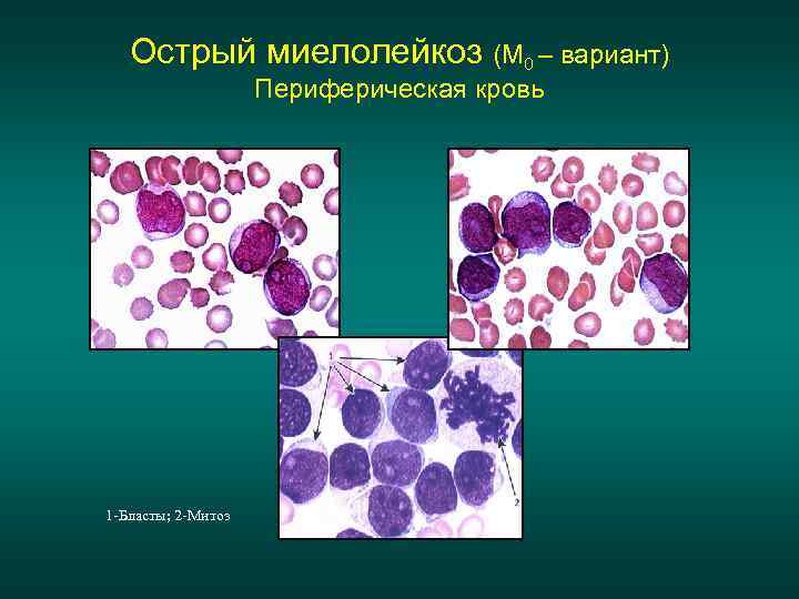   Острый миелолейкоз (М 0 – вариант)     Периферическая кровь