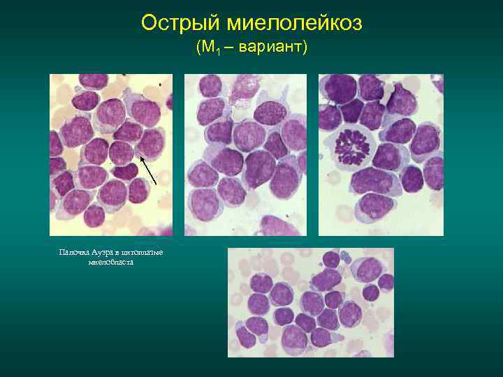 Острый лейкоз картина крови