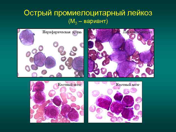 Бензольный лейкоз презентация