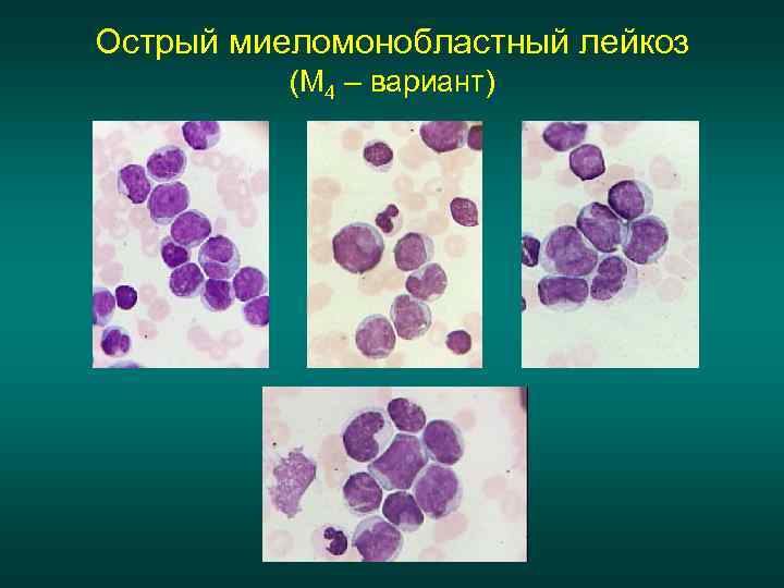 Картина острого лейкоза