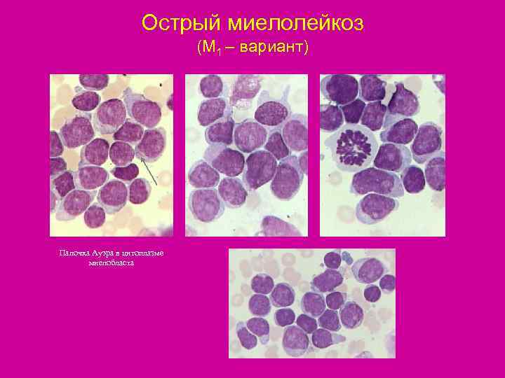     Острый миелолейкоз     (М 1 – вариант)