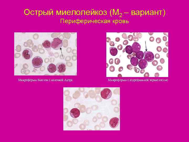   Острый миелолейкоз (М 2 – вариант)      Периферическая