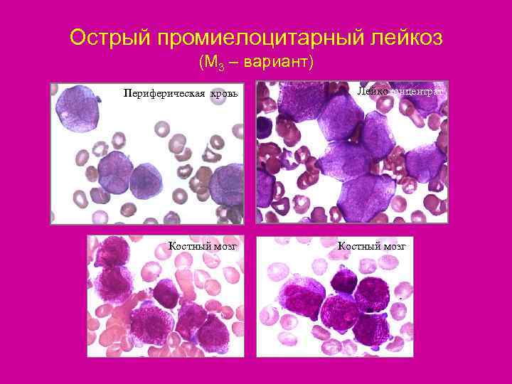 Картина крови при миелобластном лейкозе остром