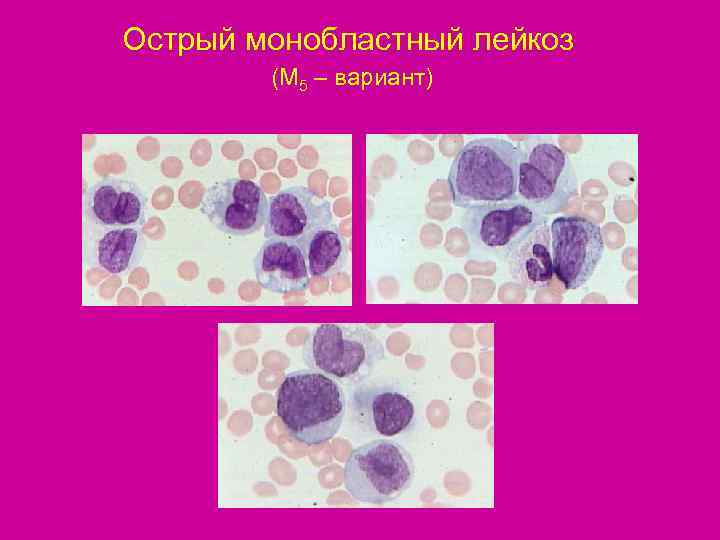Острый монобластный лейкоз   (М 5 – вариант) 
