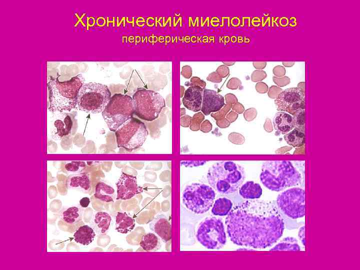 Хронический миелолейкоз периферическая кровь 
