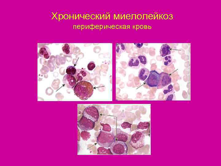 Хронический миелолейкоз периферическая кровь 