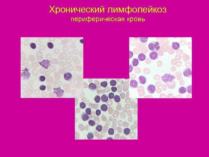 Хронический лимфолейкоз периферическая кровь 