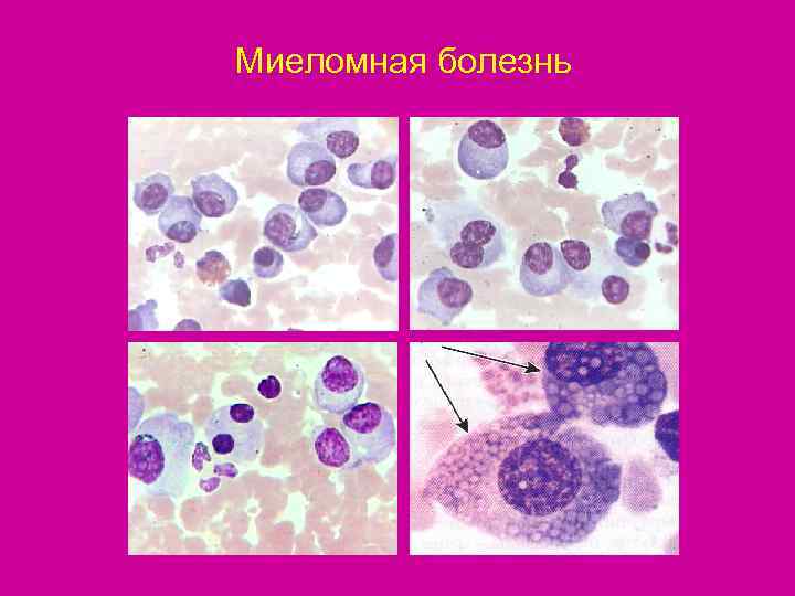 Миеломная болезнь 