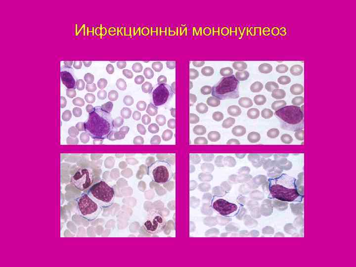 Моноклеоз. Инфекционный мононуклеоз нейтрофилез. Вирус Эпштейна-Барр атипичные мононуклеары. Инфекционный мононуклеоз патанатомия. Инфекционный мононуклеоз картина крови.