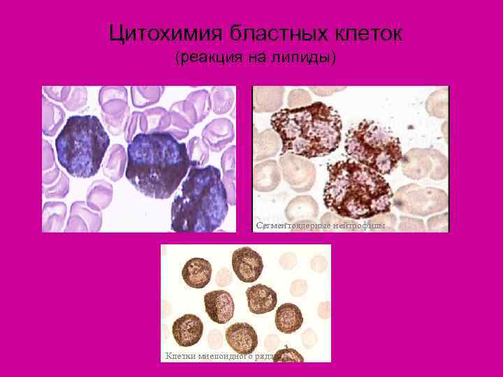 Цитохимия бластных клеток (реакция на липиды)      Сегментоядерные нейтрофилы 