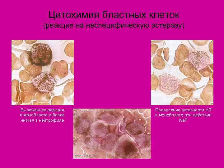   Цитохимия бластных клеток  (реакция на неспецифическую эстеразу) Выраженная реакция  