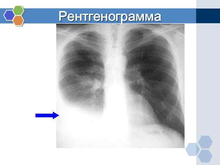 Рентгенограмма 