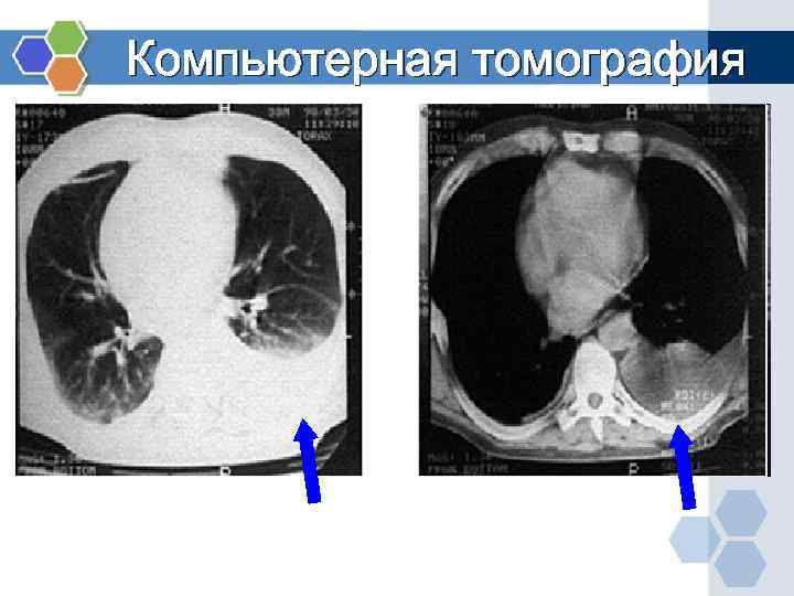 Компьютерная томография 