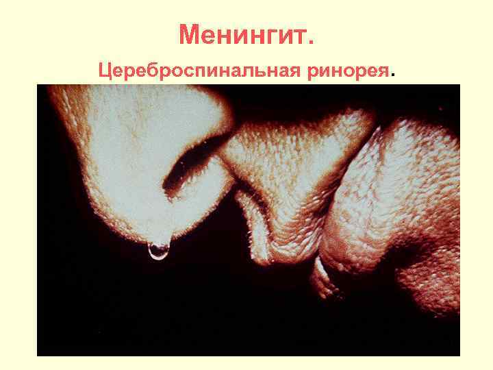  Менингит. Цереброспинальная ринорея. 