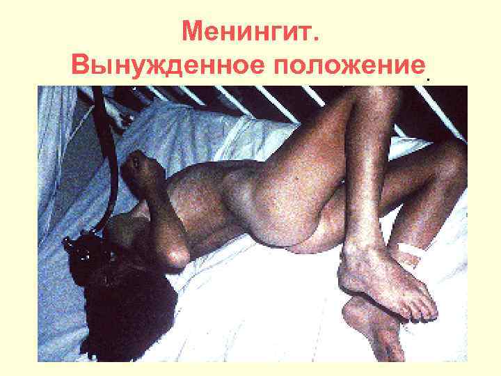 Менингит. Вынужденное положение. 
