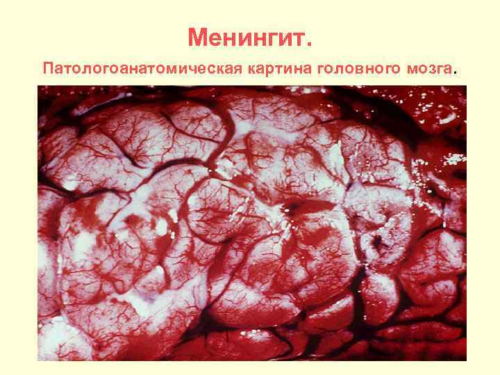     Менингит. Патологоанатомическая картина головного мозга. 